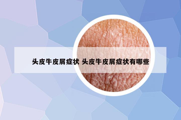 头皮牛皮屑症状 头皮牛皮屑症状有哪些