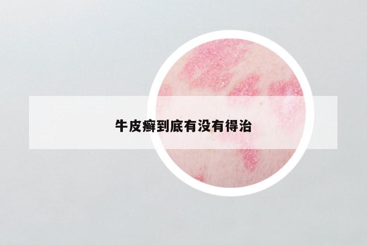 牛皮癣到底有没有得治