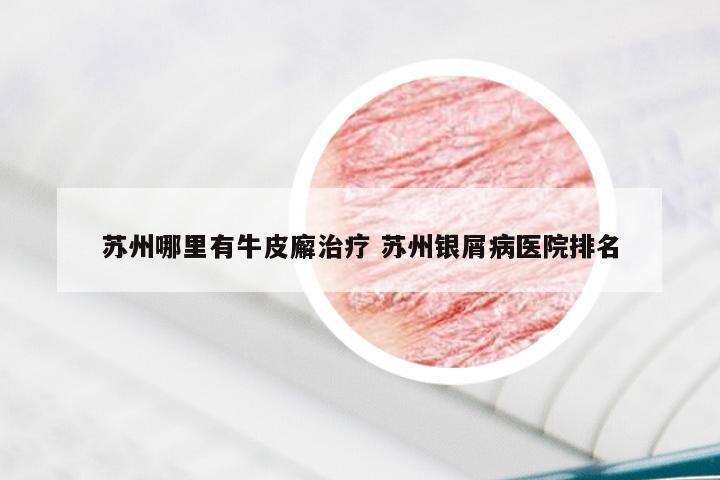 苏州哪里有牛皮廨治疗 苏州银屑病医院排名