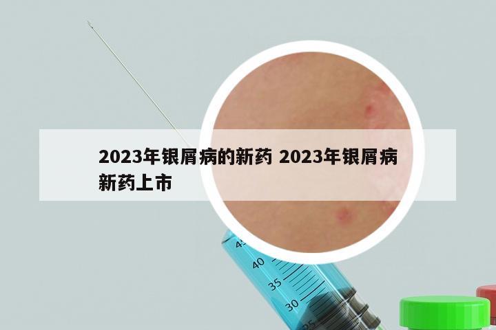 2023年银屑病的新药 2023年银屑病新药上市