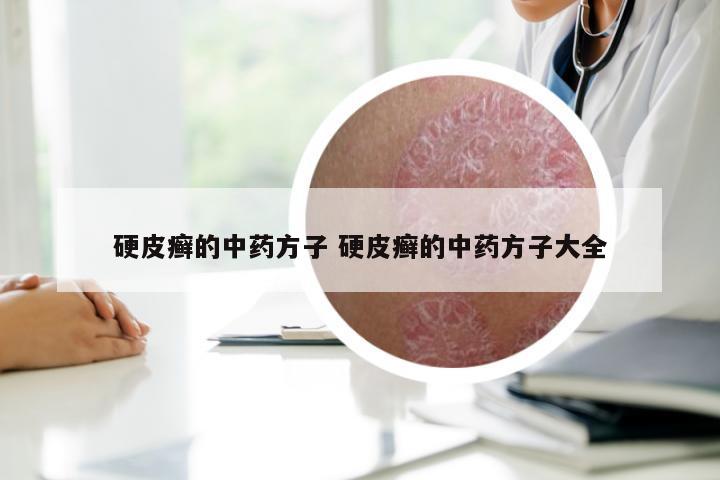 硬皮癣的中药方子 硬皮癣的中药方子大全