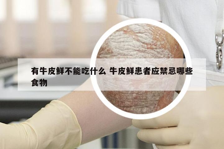 有牛皮鲜不能吃什么 牛皮鲜患者应禁忌哪些食物
