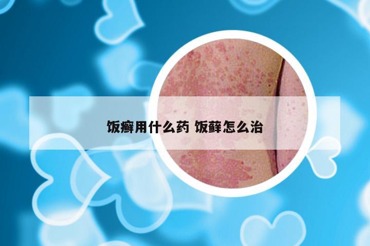 饭癣用什么药 饭藓怎么治