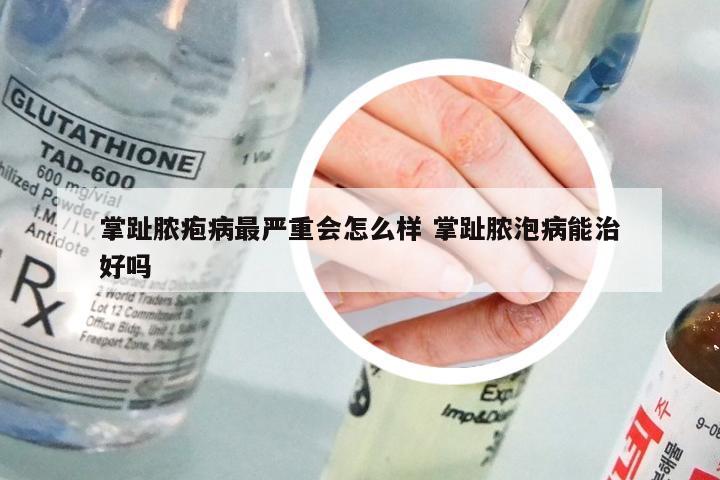 掌趾脓疱病最严重会怎么样 掌趾脓泡病能治好吗