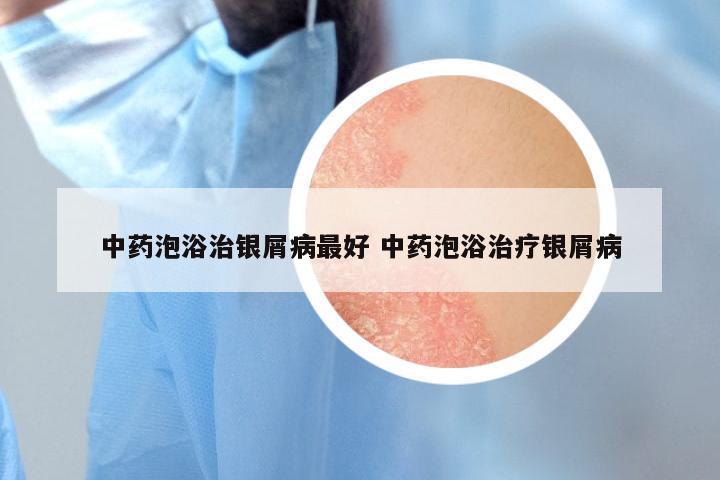 中药泡浴治银屑病最好 中药泡浴治疗银屑病