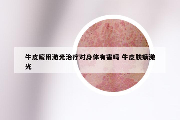 牛皮廨用激光治疗对身体有害吗 牛皮肤癣激光