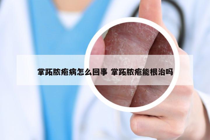 掌跖脓疱病怎么回事 掌跖脓疱能根治吗