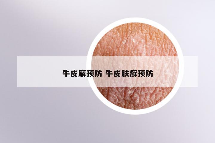 牛皮廨预防 牛皮肤癣预防