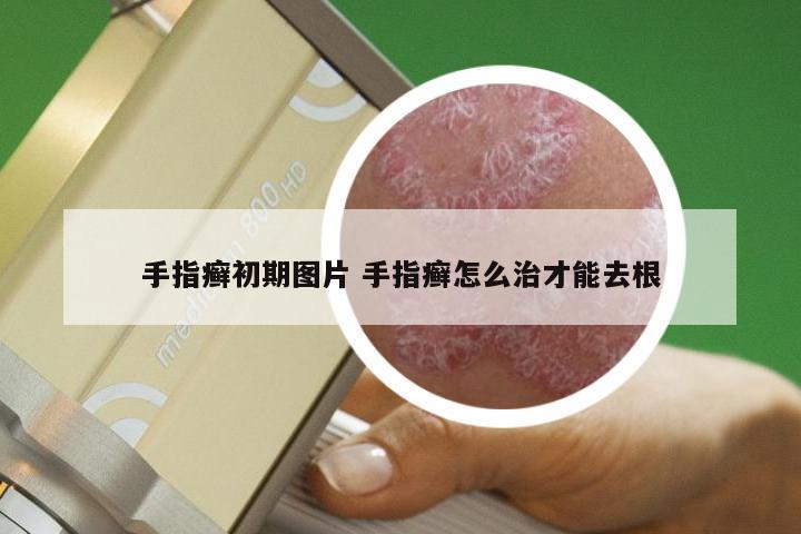 手指癣初期图片 手指癣怎么治才能去根