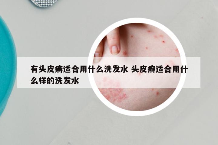 有头皮癣适合用什么洗发水 头皮癣适合用什么样的洗发水