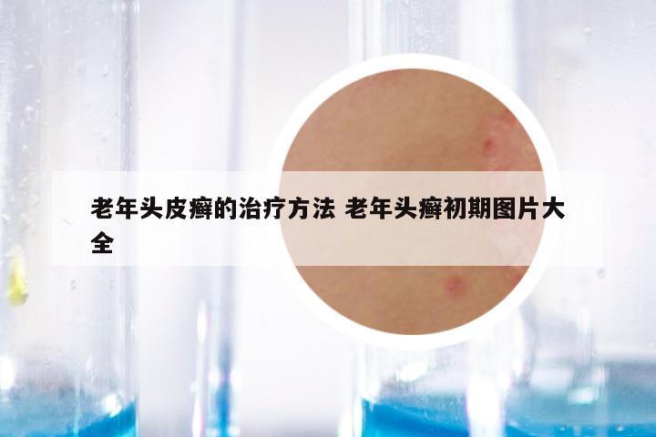 老年头皮癣的治疗方法 老年头癣初期图片大全