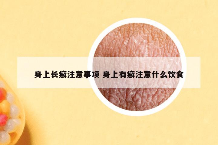 身上长癣注意事项 身上有癣注意什么饮食