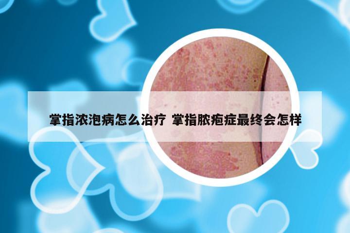 掌指浓泡病怎么治疗 掌指脓疱症最终会怎样