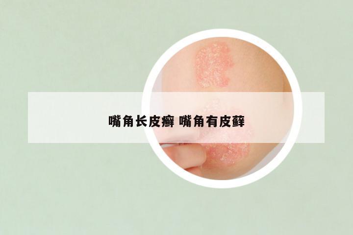 嘴角长皮癣 嘴角有皮藓
