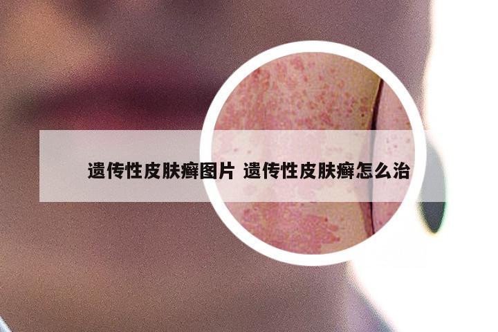 遗传性皮肤癣图片 遗传性皮肤癣怎么治
