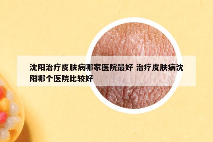 沈阳治疗皮肤病哪家医院最好 治疗皮肤病沈阳哪个医院比较好