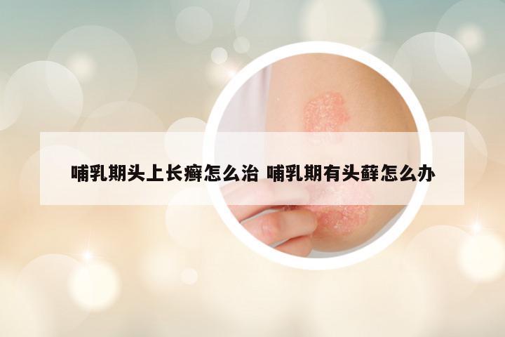 哺乳期头上长癣怎么治 哺乳期有头藓怎么办