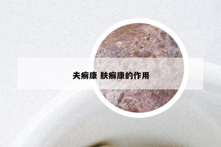 夫癣康 肤癣康的作用