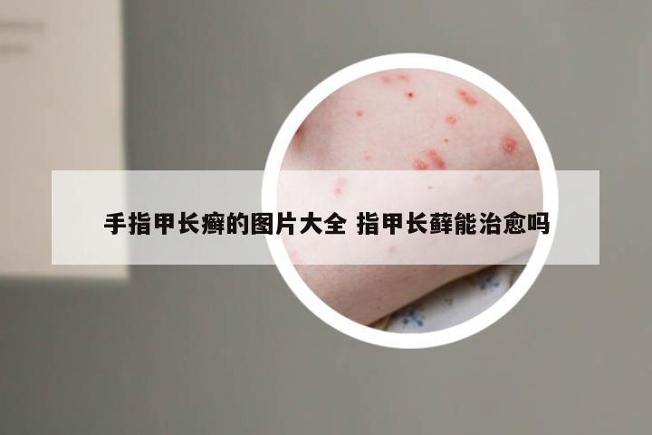 手指甲长癣的图片大全 指甲长藓能治愈吗