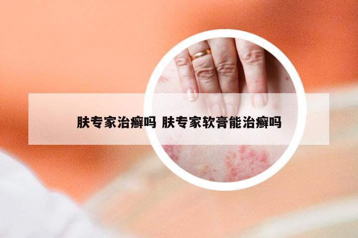 肤专家治癣吗 肤专家软膏能治癣吗