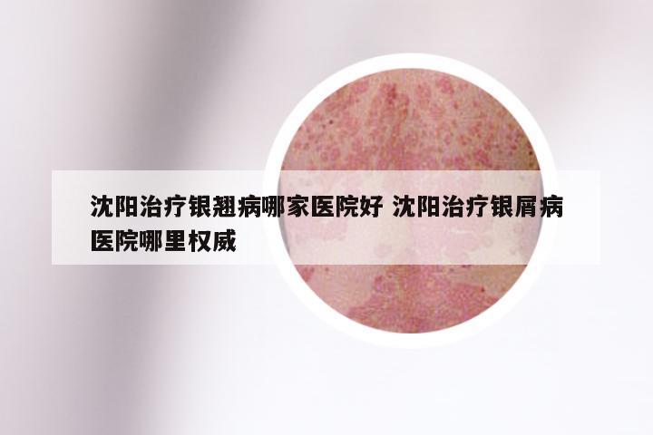 沈阳治疗银翘病哪家医院好 沈阳治疗银屑病医院哪里权威