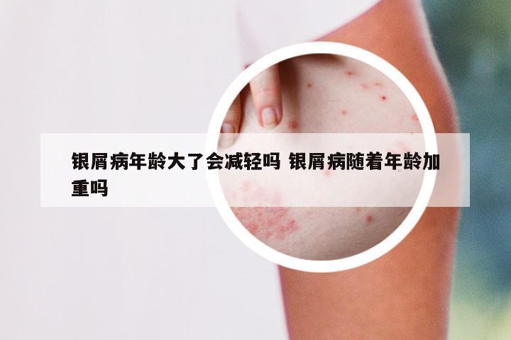 银屑病年龄大了会减轻吗 银屑病随着年龄加重吗