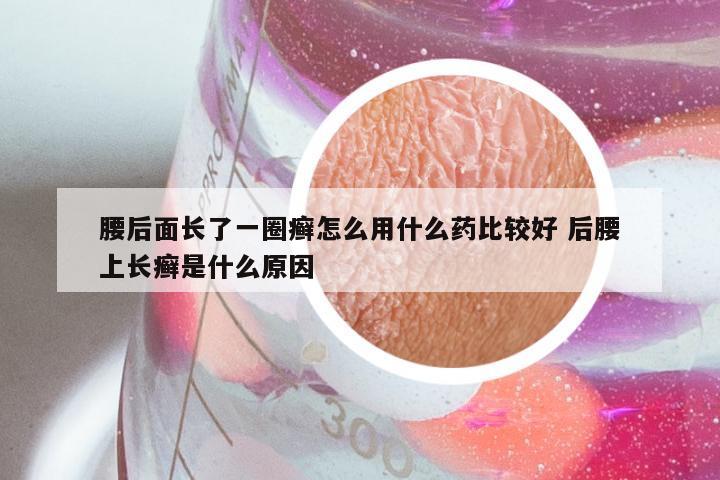 腰后面长了一圈癣怎么用什么药比较好 后腰上长癣是什么原因