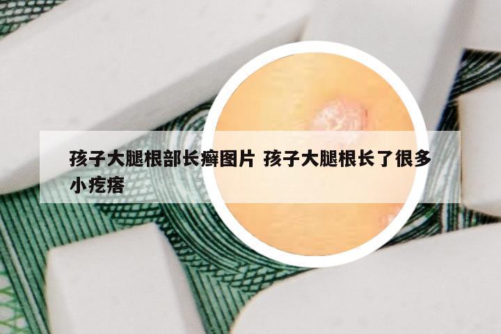 孩子大腿根部长癣图片 孩子大腿根长了很多小疙瘩