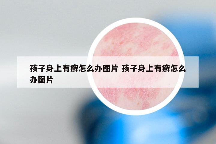 孩子身上有癣怎么办图片 孩子身上有癣怎么办图片