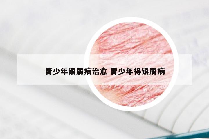 青少年银屑病治愈 青少年得银屑病