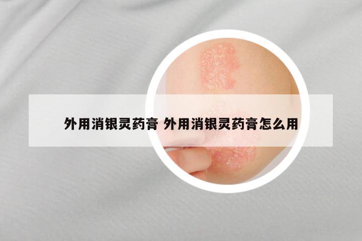外用消银灵药膏 外用消银灵药膏怎么用