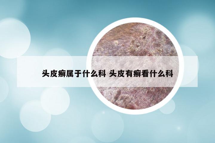 头皮癣属于什么科 头皮有癣看什么科