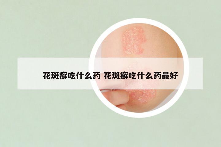 花斑癣吃什么药 花斑癣吃什么药最好