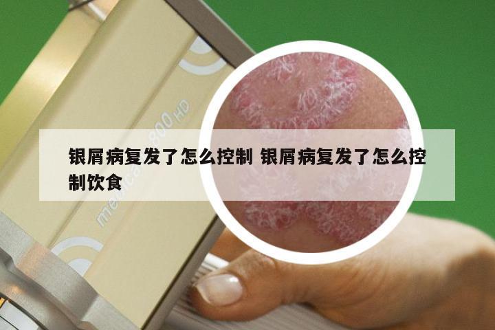 银屑病复发了怎么控制 银屑病复发了怎么控制饮食