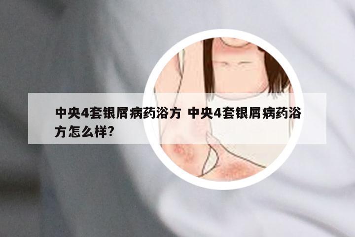 中央4套银屑病药浴方 中央4套银屑病药浴方怎么样?