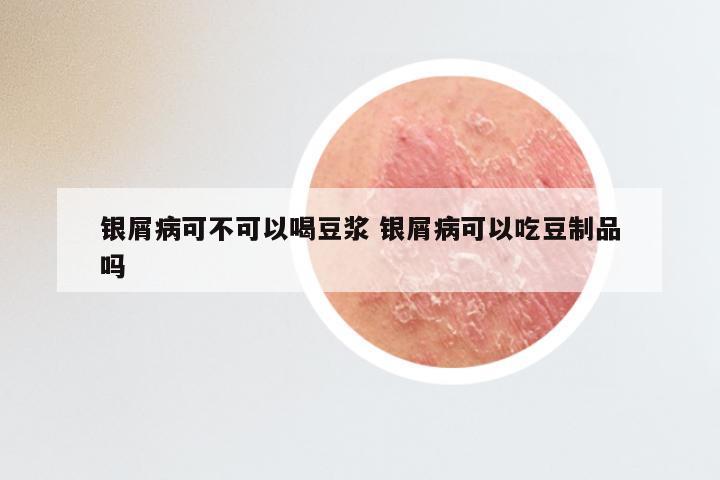 银屑病可不可以喝豆浆 银屑病可以吃豆制品吗