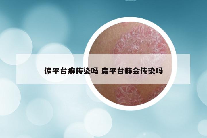 偏平台癣传染吗 扁平台藓会传染吗