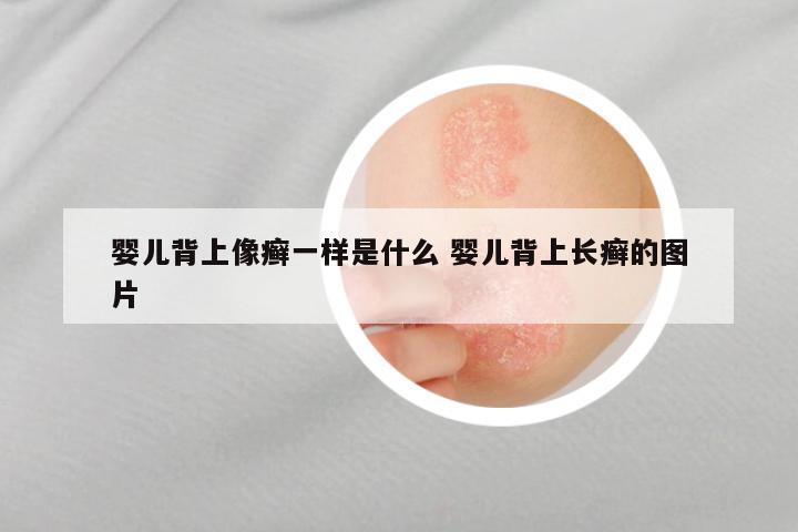 婴儿背上像癣一样是什么 婴儿背上长癣的图片