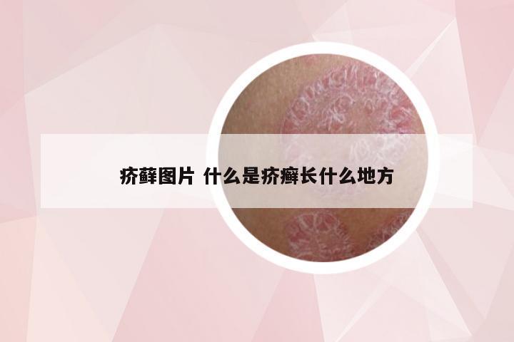 疥藓图片 什么是疥癣长什么地方