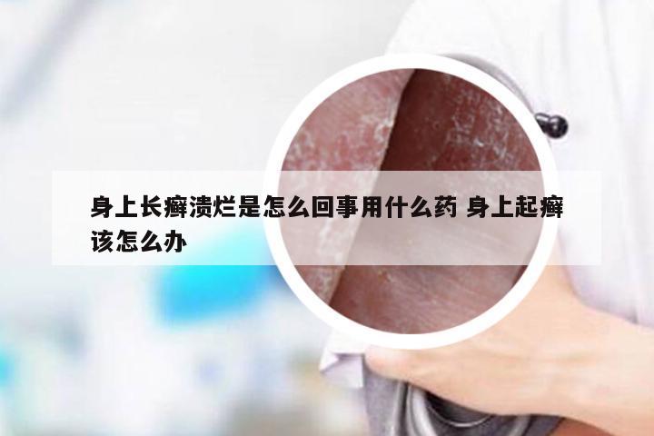 身上长癣溃烂是怎么回事用什么药 身上起癣该怎么办