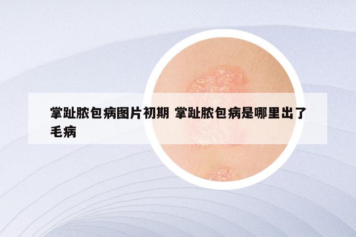 掌趾脓包病图片初期 掌趾脓包病是哪里出了毛病