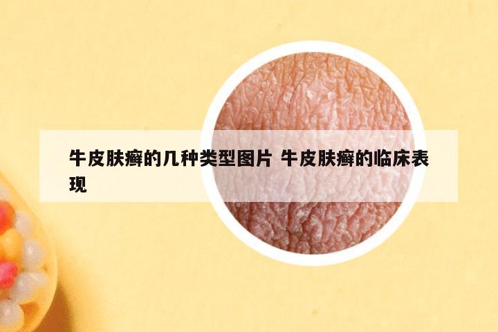 牛皮肤癣的几种类型图片 牛皮肤癣的临床表现