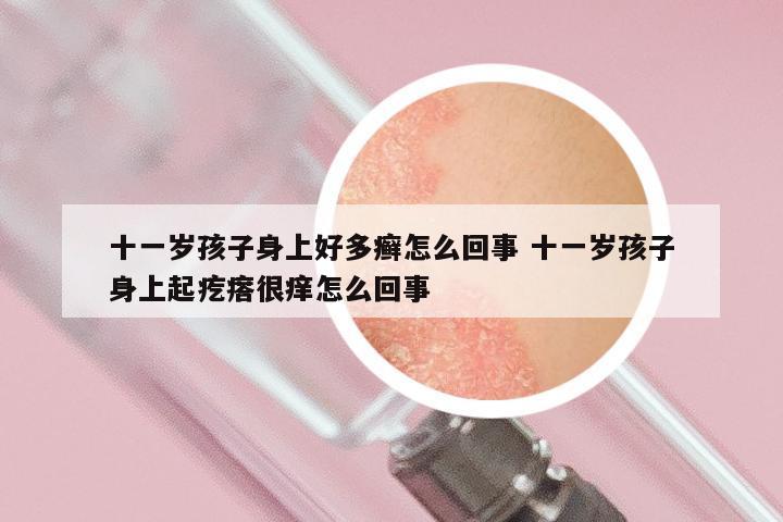 十一岁孩子身上好多癣怎么回事 十一岁孩子身上起疙瘩很痒怎么回事