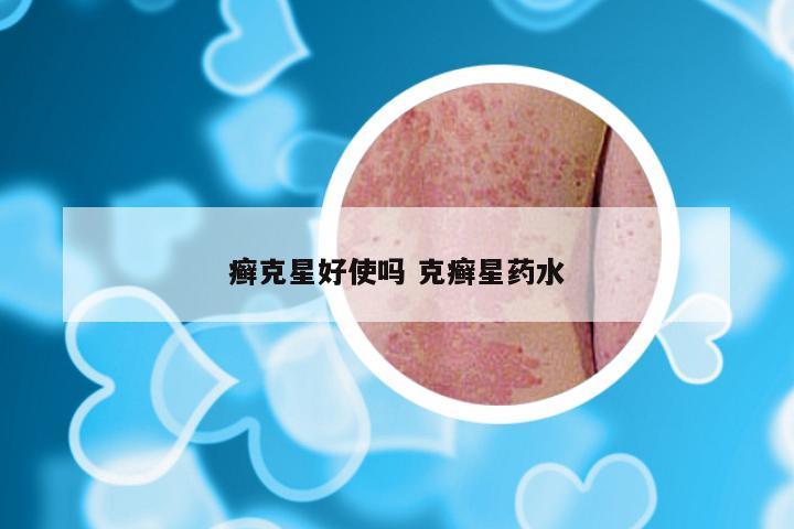 癣克星好使吗 克癣星药水