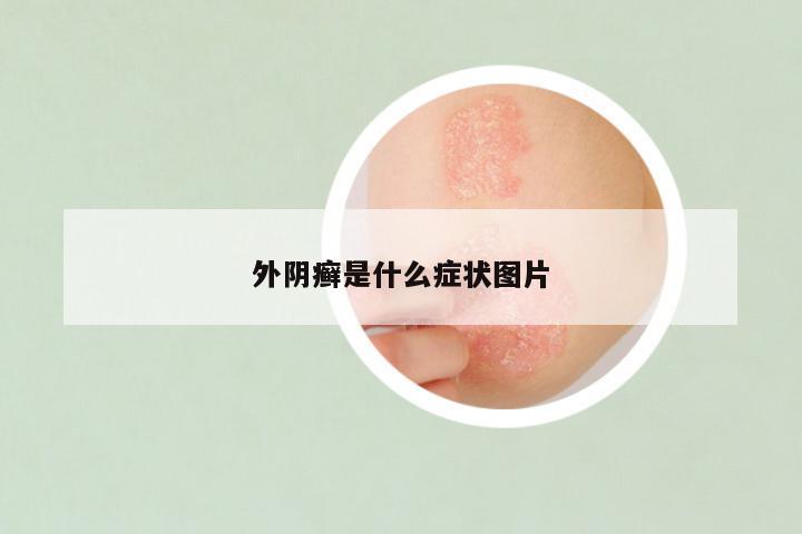 外阴癣是什么症状图片
