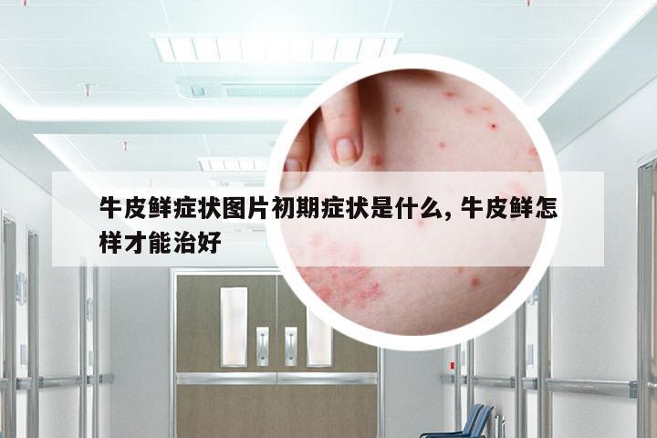 牛皮鲜症状图片初期症状是什么, 牛皮鲜怎样才能治好