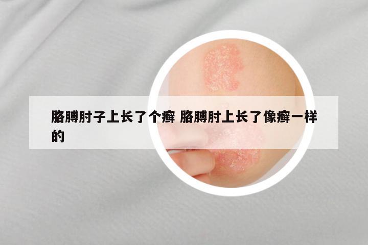 胳膊肘子上长了个癣 胳膊肘上长了像癣一样的