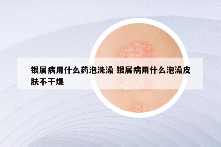 银屑病用什么药泡洗澡 银屑病用什么泡澡皮肤不干燥