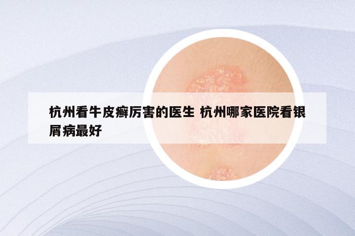 杭州看牛皮癣厉害的医生 杭州哪家医院看银屑病最好