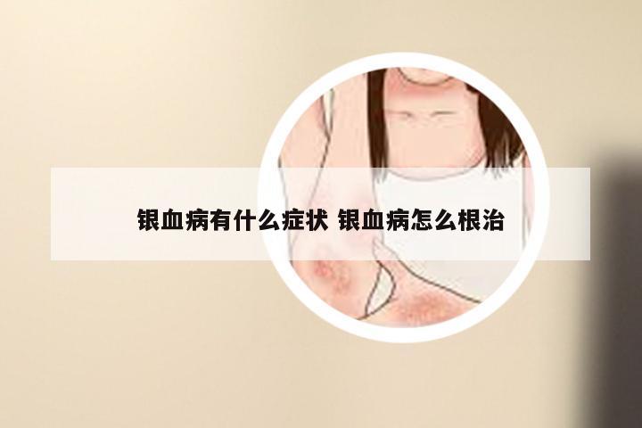 银血病有什么症状 银血病怎么根治
